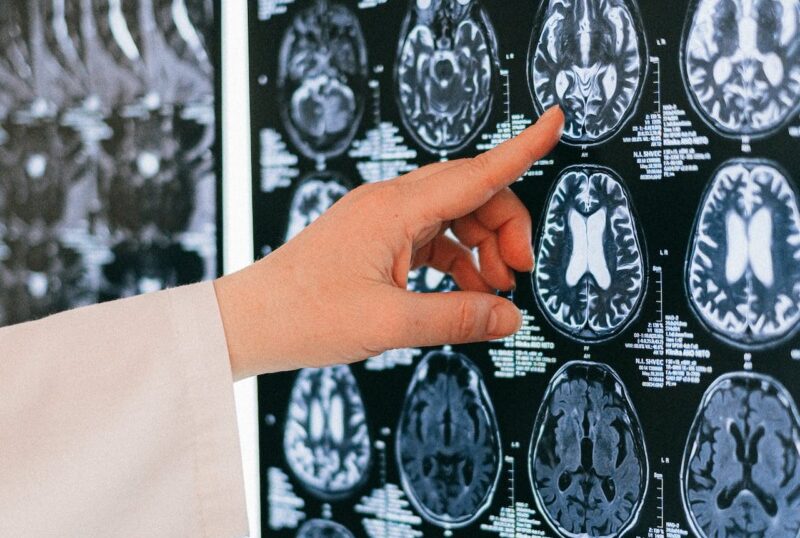 Bolile mintale grave, asociate cu o speranţă de viaţă mai scurtă / Studiu pe aproape 180.000 de pacienţi