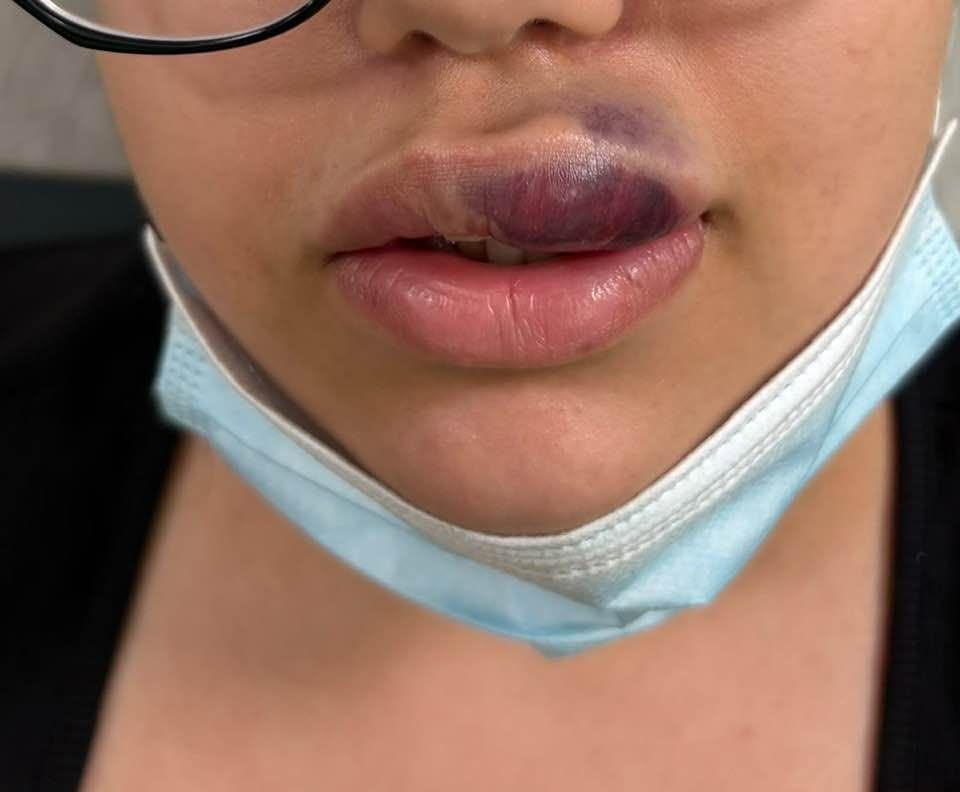 O adolescentă din Oradea era să-și piardă o parte din buză, după o injecție cu acid hialuronic într-un salon clandestin / Procedura a fost efectuată într-un salon de tatuaje / Autoarea, căutată de Poliție