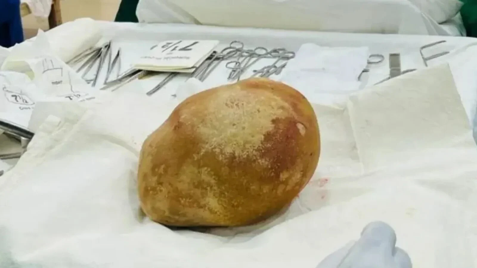 Piatră la vezică de 3,1 kg scosă de medici în Sri Lanka