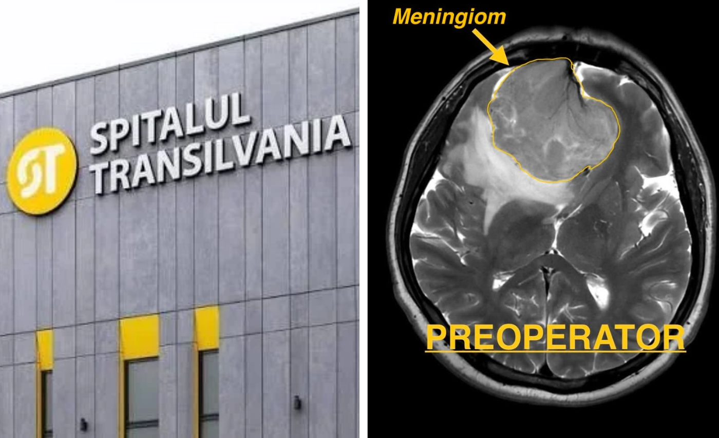 Cum a schimbat o operație extrem de complexă la un spital din Cluj viața unui pacient: Doi ani i s-a spus că i s-a schimbat firea, era o tumoră pe creier